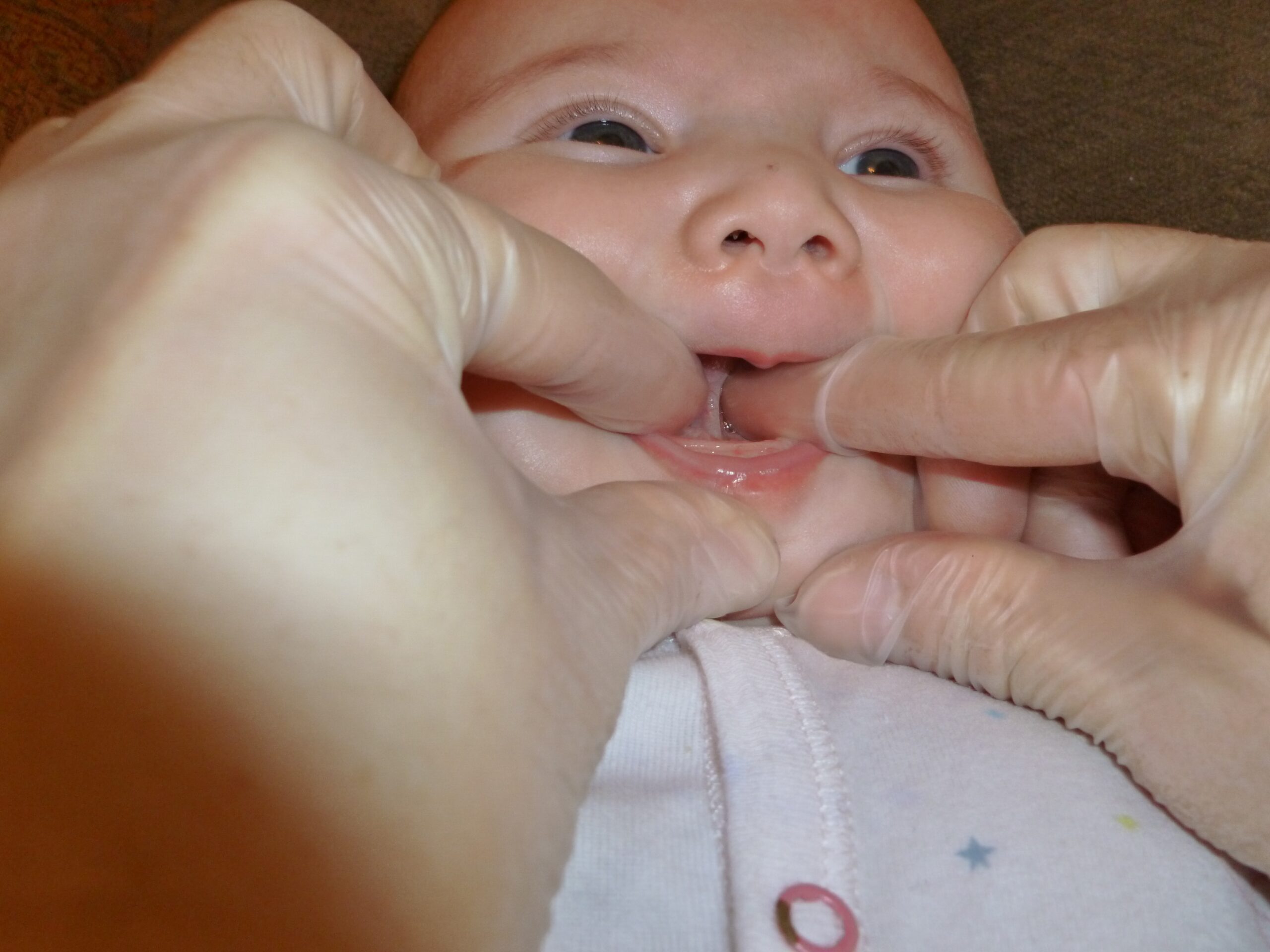 The Basics of Tongue and Lip Tie: Related Issues, Assessment and Treatment