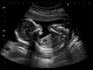 Exploring The Potential Emotional Impact Of The Prenatal Ultrasound