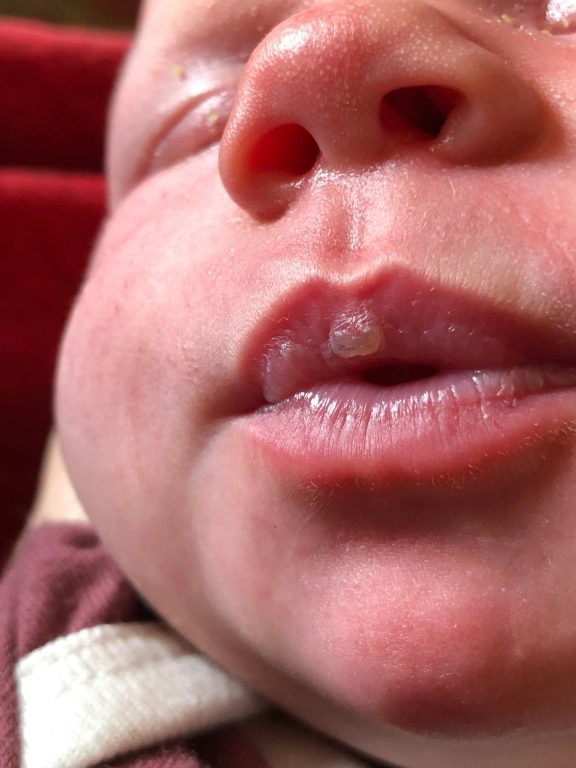 Lip blisters, babies, and breastfeeding